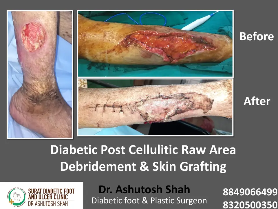 Diabetic Cellulitis and Coverage.pptx-20.webp